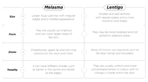 melasma and lentigo